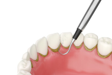 Dental tartar removal tool effectively eliminating dental calculus, oral hygiene and health concept. 3D rendering.