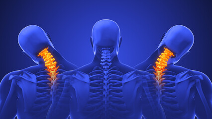 Medical animation for neck discomfort