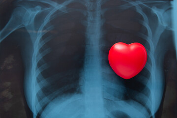 Red heart on x ray chest.