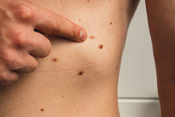 Male hand showing birthmarks on skin body stomach part. Close up detail of the bare skin. Health...