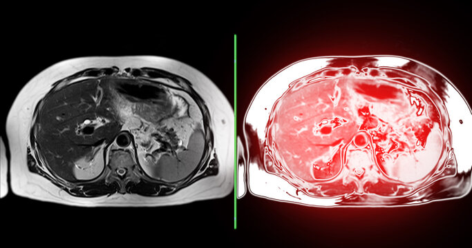 MRI of the upper abdomen  is a non-invasive imaging technique providing detailed visuals of organs like the liver, pancreas, and kidneys in case normal study.