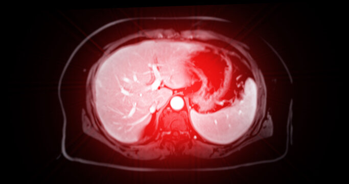 MRI of the upper abdomen  is a non-invasive imaging technique providing detailed visuals of organs like the liver, pancreas, and kidneys in case normal study.