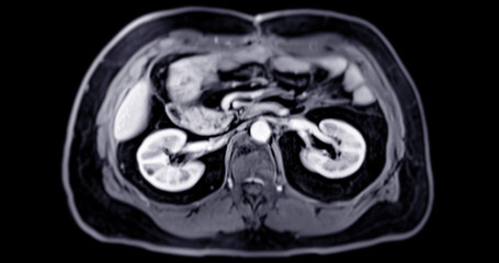 MRI of the upper abdomen  is a non-invasive imaging technique providing detailed visuals of organs...