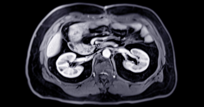 MRI of the upper abdomen  is a non-invasive imaging technique providing detailed visuals of organs like the liver, pancreas, and kidneys in case normal study.