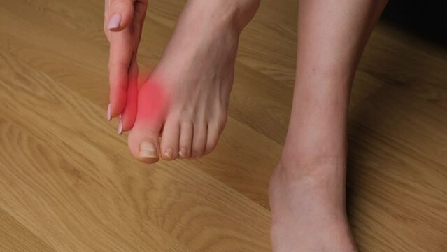 Close-up of a woman's feet with hallux valgus. Leg pain with red light.