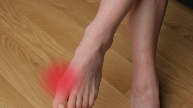 Close-up of a woman's feet with hallux valgus. Leg pain with red light.