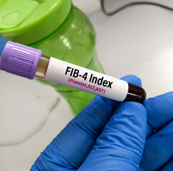 Blood sample for FIB-4 (Fibrosis-4) test, diagnosis of liver disease.