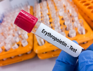 Blood sample for Erythropoietin (EPO) test, stimulating hormone for RBC production.