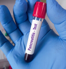 Blood sample for pancreatitis test. serum amylase test, lipase test.