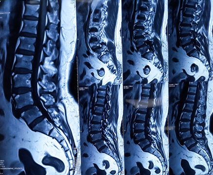 MRI scan of sacro-lumbar spines of a patient with chronic back pain and weakness of leg. The MRI shows degenerative changes of L spines, lumbar discs herniation and nerve roots.