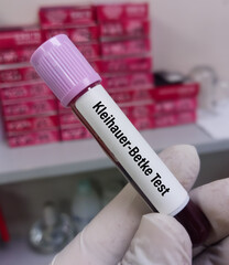Kleihauer–Betke test or Kleihauer test, is utilized to determine if there is fetal blood in...