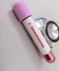 Blood sample for 11-ketotestosterone test, biomarkers for androgen production of adrenal origin.