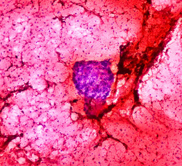 Photomicrograph of Osteolytic lesion of left proximal radium, Positive for malignant cell, small...