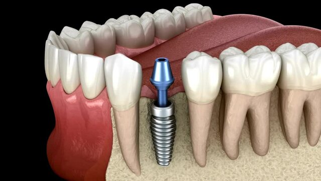 Premolar tooth recovery with implant. Medically accurate 3D animation of human teeth and dentures concept Video
