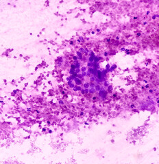 CT guided FNA from lung lesion, Chronic granulomatous inflammation (CGI) with Tuberculosis. CGI-TB. smear show clusters of epithelioid cells, lymphocytes, histiocytes, giant cells and fibrous tissues.