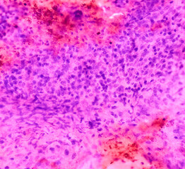Photomicrograph of Chronic granulomatous inflammation (CGI) with Tuberculosis. CGI-TB. Iliac bone lesion cytology. smear show clusters of epithelioid cells, lymphocytes, histiocytes, giant cells.