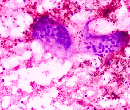 Photomicrograph Of Chronic Granulomatous Inflammation (CGI) With Tuberculosis. CGI-TB. Iliac Bone Lesion Cytology. Smear Show Clusters Of Epithelioid Cells, Lymphocytes, Histiocytes, Giant Cells.