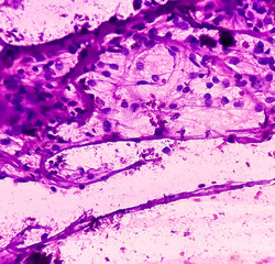 Swelling of leg (FNA cytology). Synovitis. smear show polymorphs, lymphocytes, giant cells and blood. Inflammation of the synovial membrane.