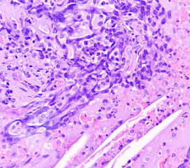 Lung cancer - adenocarcinoma, mucinous type. Therapies for specific genetic mutations (biomarkers EGFR, ALK, ROS1, BRAF, PDL1, KRAS) are appropriate for selected cases. - obrazy, fototapety, plakaty