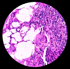 Lung cancer - adenocarcinoma, reactive change, lymph node show fibro collagenous tissue and neural...