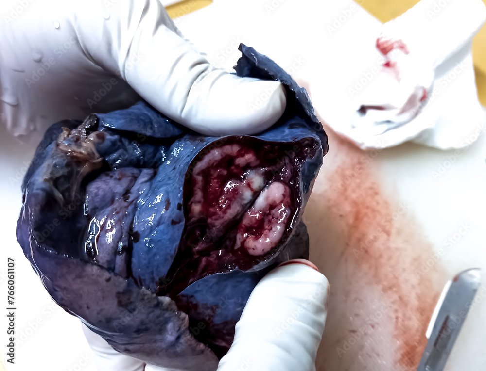 Sticker Lung cancer - Lung tumor. cut section of left lung for histological examination. sample on surgeon hands.