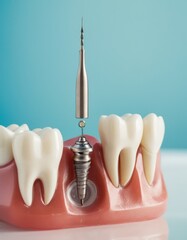 A dental implant model showcasing a metal implant in the jawbone with surrounding healthy teeth, illustrating dental surgery and prosthetics.