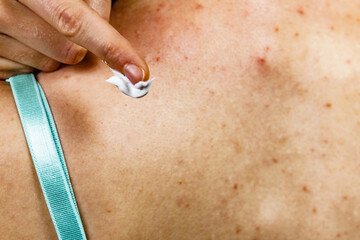 Woman with pimple on back applying medical ointmeny