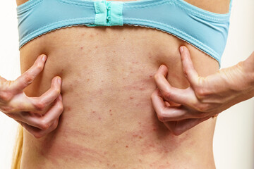 Woman scratching her itchy back with allergy rash - 766253198
