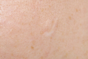 Fototapeta premium Skin texture and scar. Close-up stock photo of human skin in best quality.