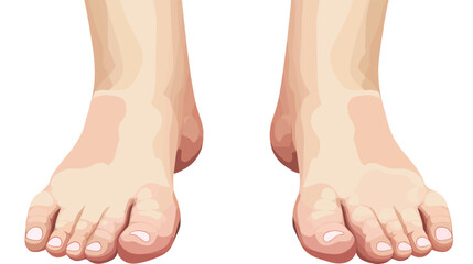 Foot massage. Bunion. Hallux valgus or bunion