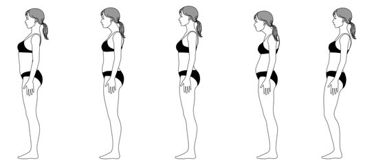 女性の正しい姿勢と悪い姿勢の比較イラストセット 猫背やストレートネックを示す全身横向き図解