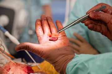 The doctor shows the cancerous tumor that he removed during the operation. Real operating room.