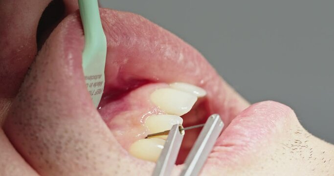 Extreme Close-Up of Dentist Using Electronic Periodontal Probe