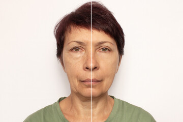 Close-up of an elderly woman's face before and after a facelift. Rejuvenation procedure, Botox....