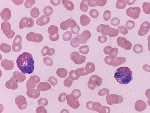 Two eosinophils seen on peripheral blood smear
