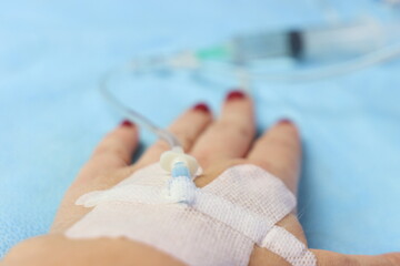 Peripheral catheter access in a woman’s hand. Close up of a arterial catheter