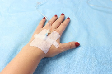 Peripheral catheter access in a woman’s hand. Close up of a arterial catheter