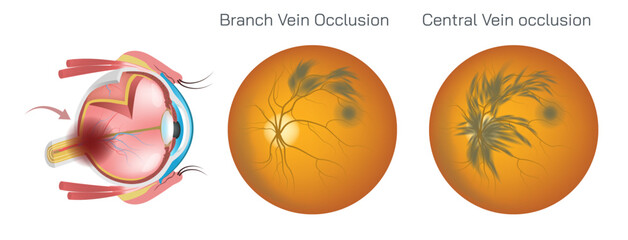 Branch or Central retinal vein occlusion is a serious eye condition that occurs when the main vein that drains blood from the retina or obstructed and impairs blood flow. Eye disease vector.