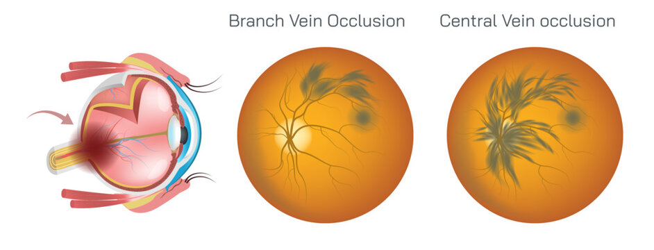 Branch or Central retinal vein occlusion is a serious eye condition that occurs when the main vein that drains blood from the retina or obstructed and impairs blood flow. Eye disease vector.