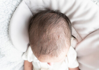 Seborrheic dermatitis crusts on the baby's head. Child with seborrhea in the hair, newborn skin...