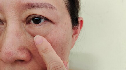 Portrait showing the finger holding the flabbiness and loose under the eye, dark spots and blemish,...