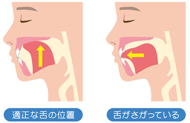 正しい舌の位置と下がっている舌の位置 - obrazy, fototapety, plakaty