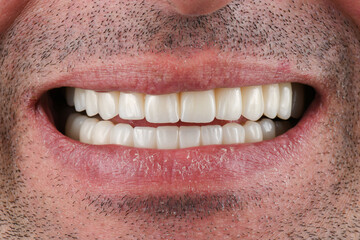 Obraz premium emax ceramic cowens on implants 