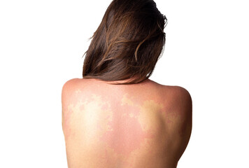 woman face and body with red big spots,alcohol allergy over the skin.girl female back isolated on white, close up half face. 