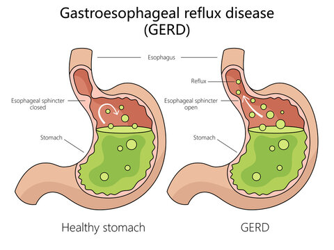 Human gastroesophageal reflux disease structure diagram hand drawn schematic raster illustration. Medical science educational illustration