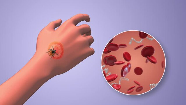 CDC in blood cells with lyme disease on hand