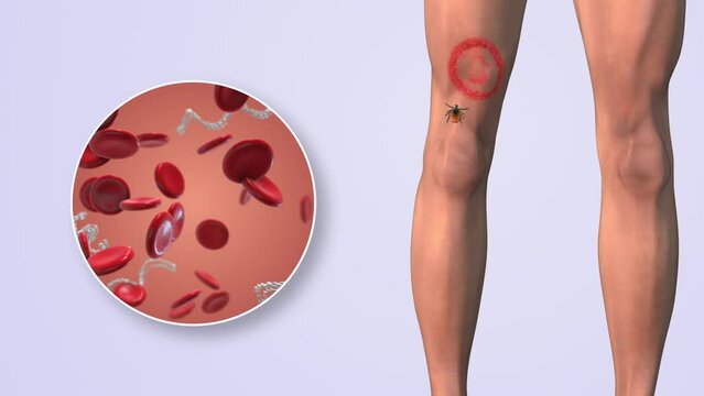 CDC in blood cells with lyme disease on thighs