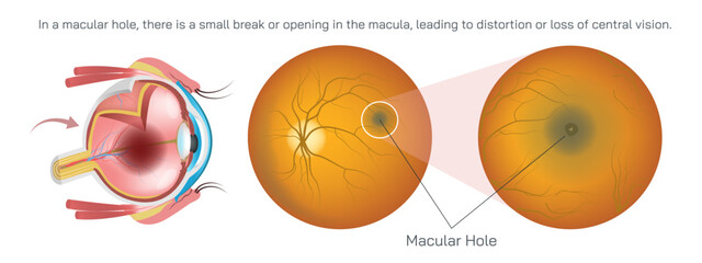 macula is responsible for sharp vision to do activities like reading and driving. In a macular hole, there is a small break or opening in the macula, leading to distortion or loss of vision vector.