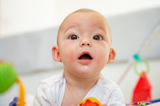 Close-up portrait of a baby with atopic dermatitis on the skin, redness of the cheeks, rash, eczema or hives caused by infection or excessive salivation from teething. newborn health and care concept