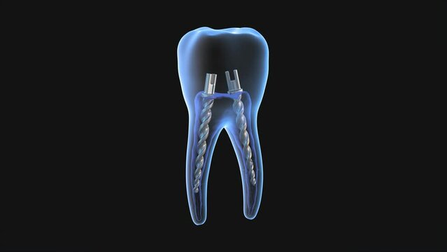 Dental steel post inside molar teeth, Xray view. Dental endodontic treatment 3D render illustration